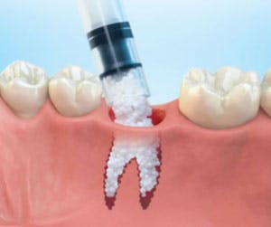 Grafts for a Dental Implant 01